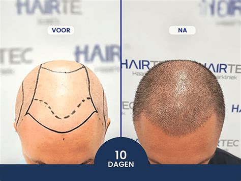 Haartransplantatie En Haarherstel: Wat Zijn De Opties?