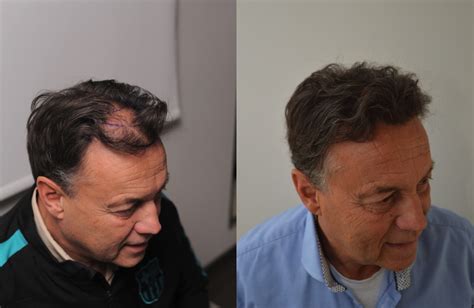 Haartransplantatie Voor Mannen: Specifieke Informatie