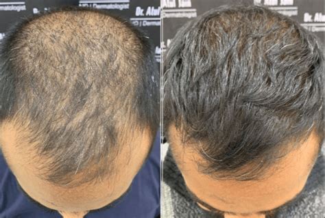 Hoe Haartransplantatie Je Levensstijl Kan Veranderen