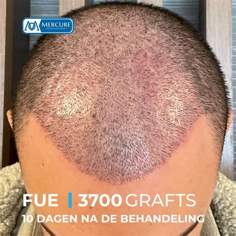 Voor- En Nadelen Van Saffier FUE Haartransplantatie